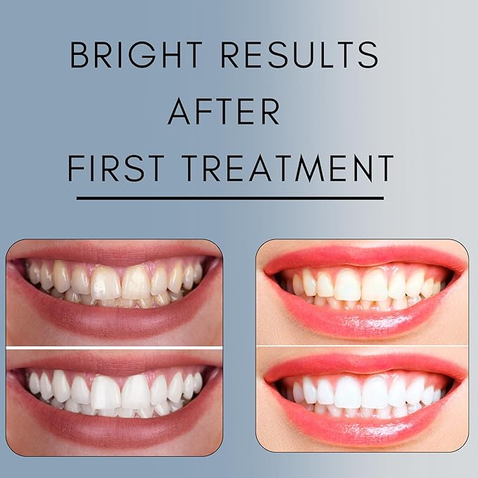 Teeth Whitening Gel Refill for Trays - Professional Strength 44% Carbamide Peroxide Formula - Fast & Effective Bleaching Solution for a Brighter Smile