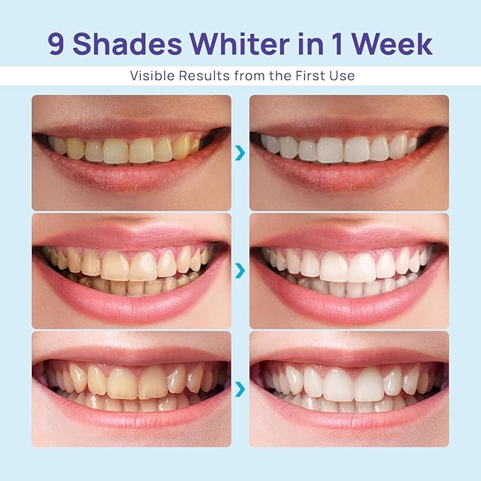 Whitebite Pro Teeth Whitening Kit for Sensitive Teeth – LED Light + 35% Carbamide Peroxide Gel + Remineralizing Gel | Dental-Grade Results at Home