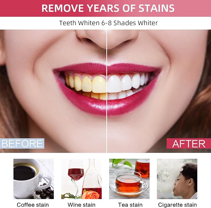 Professional Teeth Whitening Kit with 5 Teeth Whitening Gel, LED Accelerator Light & Rechargeable Design - Enamel Safe Gel, Custom Trays, Fast Results for Sensitive Teeth - Whitening Gel Kit