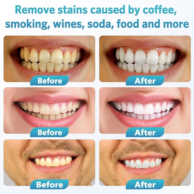 BESTEK Teeth Whitening Kit – 32X LED Light, 10-Min Fast Whitening, 4 Tubes of 35% Carbamide Peroxide Gel, Removes Coffee, Wine & Tobacco Stains - Yellow