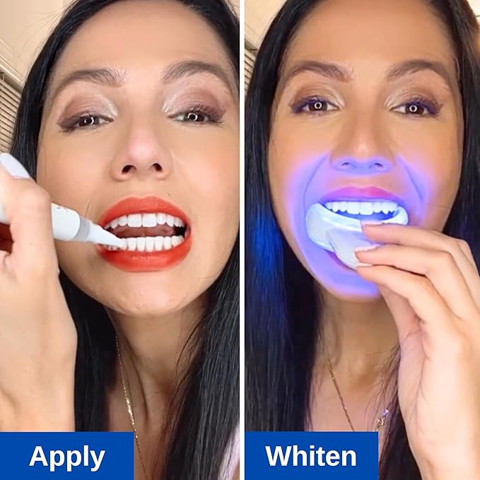 Polar MD Teeth Whitening Kit, Professional Teeth Whitener Gel Pens, 1YR. Supply, Compare to Whitening Strips. Powerful 32 LED Wireless Activating Light.